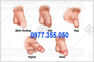 các bệnh về bao quy đầu ở nam giới