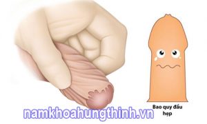 hẹp bao quy đầu ở nam giới