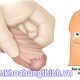 hẹp bao quy đầu ở nam giới