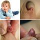 Hình ảnh hẹp bao quy đầu ở trẻ nhỏ phổ biến hiện nay