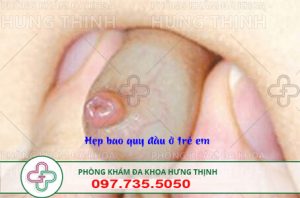 chữa hẹp bao quy đầu cho trẻ