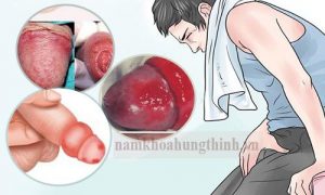 triệu chứng viêm bao quy đầu