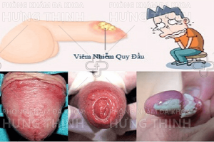 Viêm bao quy đầu có nguy hiểm không, có tự khỏi được không?
