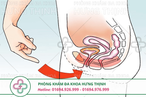Xuất tinh ngược là gì, nguyên nhân và cách chữa