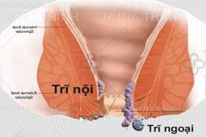Bệnh trĩ nội là gì? Cách chữa bệnh trĩ nội hiệu quả