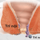 Bệnh trĩ nội là gì? Cách chữa bệnh trĩ nội hiệu quả
