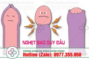 địa chỉ chữa nghẹt bao quy đầu