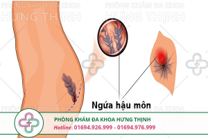 Ngứa hậu môn là gì, nguyên nhân và cách điều trị