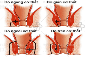 Rò hậu môn là gì, có nguy hiểm không?