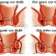 Rò hậu môn là gì, có nguy hiểm không?
