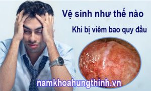 cách vệ sinh khi bị viêm bao quy đầu