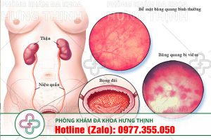 viem-bang-quang-la-gi