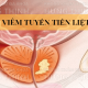 Viêm tiền liệt tuyến có nguy hiểm không?