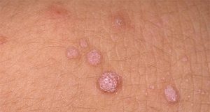 Bệnh mụn cóc sinh dục - nguyên nhân - triệu chứng và cách chữa