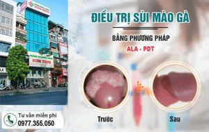 chi phí điều trị bệnh sùi mào gà