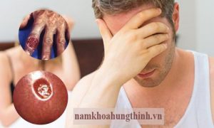Giang mai có nguy hiểm không