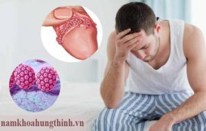 Chữa sùi mào gà ở đâu tốt?