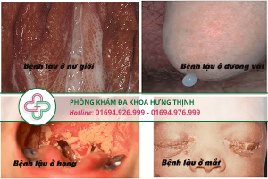 Hướng dẫn sử dụng thuốc chữa bệnh lậu hiệu quả