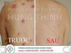 Nguyên nhân, triệu chứng, cách chữa bệnh giang mai