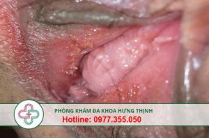 sùi mào gà là gì