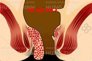Bệnh trĩ nội độ 3 và trĩ nội độ 4 là gì ? Cách chữa bệnh hiệu quả