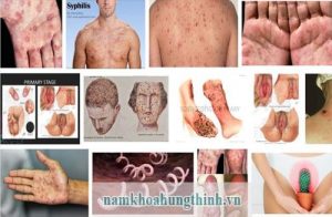 Giang mai bệnh xã hội nguy hiểm nhất
