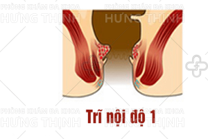 Cách chữa bệnh trĩ nội độ 1 hiệu quả