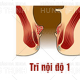 Cách chữa bệnh trĩ nội độ 1 hiệu quả