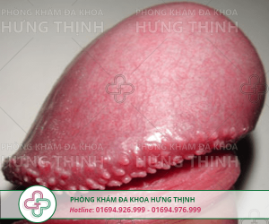 Gai sinh dục nam và những điều cần biết