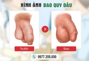 Hình ảnh trước và sau khi cắt bao quy đầu