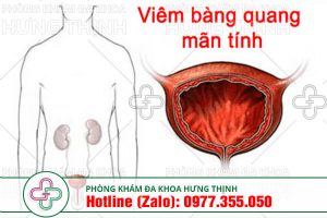 viêm bàng quang mãn tính