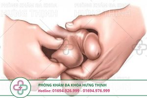 Đau tinh hoàn là gì ? Nguyên nhân, triệu chứng cách chữa đau tinh hoàn