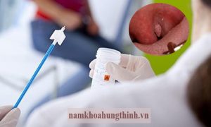 Quy trình xét nghiệm sùi mào gà