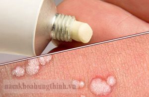 Thuốc điều trị sùi mào gà