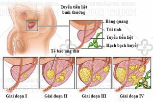 U xơ tiền liệt tuyến là gì ? Nguyên nhân, triệu chứng và cách chữa trị