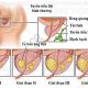 U xơ tiền liệt tuyến là gì ? Nguyên nhân, triệu chứng và cách chữa trị