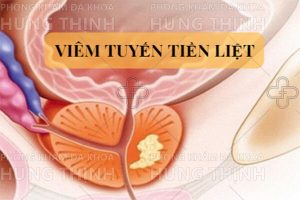 Viêm tuyến tiền liệt là gì ? Nguyên nhân, triệu chứng, cách chữa trị