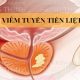 Viêm tuyến tiền liệt là gì ? Nguyên nhân, triệu chứng, cách chữa trị