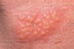Bệnh Herpes sinh dục là bệnh gì? Nguyên nhân, triệu chứng, cách chữa
