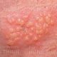 Bệnh Herpes sinh dục là bệnh gì? Nguyên nhân, triệu chứng, cách chữa