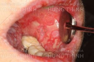 Bệnh Lậu Ở Miệng Nguyên nhân, Triệu Chứng Và Lây Qua Đâu?