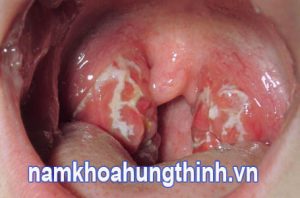 Hình ảnh bệnh lậu ở miệng