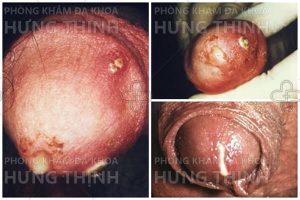 Nguyên nhân triệu chứng và cách điều trị bệnh lậu ở nam giới