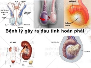 Đau tinh hoàn phải: Nguyên nhân, triệu chứng và cách chữa