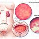 Viêm bàng quang cấp tính: Nguyên nhân, triệu chứng và cách điều trị