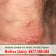 vùng kín nổi mụn là biểu hiện của bệnh gì