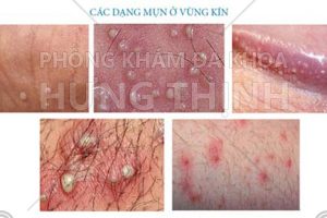 Vùng kín nổi mụn - Nguyên nhân và cách chữa