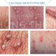 Vùng kín nổi mụn - Nguyên nhân và cách chữa