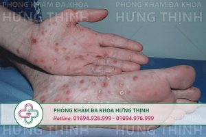 Bệnh giang mai ở nam giới - Nguyên nhân, triệu chứng, cách chữa