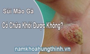 sùi mào gà có chữa khỏi được không